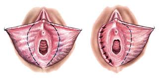 V-образная коррекция малых половых губ